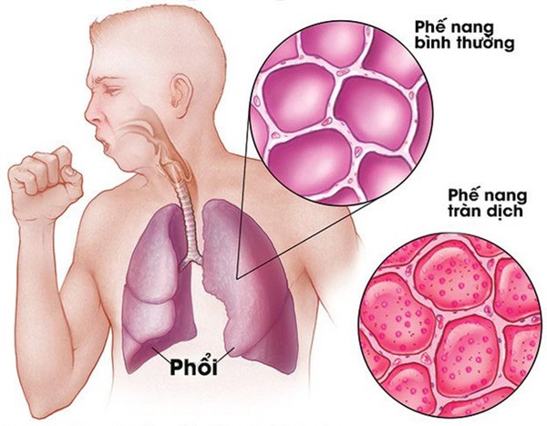 Người bệnh sẽ ho ra chúng, cùng với chất nhầy, các mảnh vụn, bụi bẩn và cả hàng triệu virus Covid-19 vừa được nhân lên nhưng chưa kịp chui vào các tế bào phổi mới. Điều này gây ra một loạt các triệu chứng bao gồm sốt, ho, khó thở và viêm phổi.